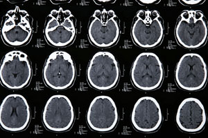 Traumatic Brain Injury Attorney