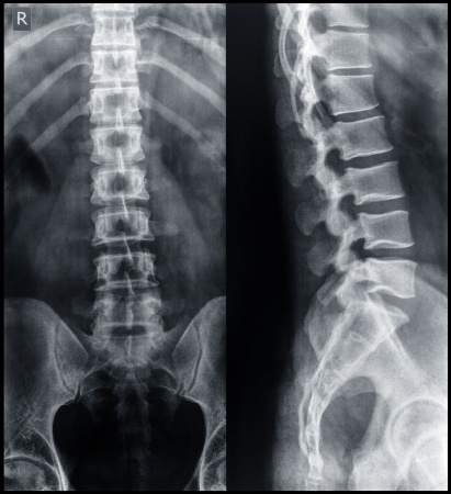 The Real Financial Costs of a Spinal Cord Injury